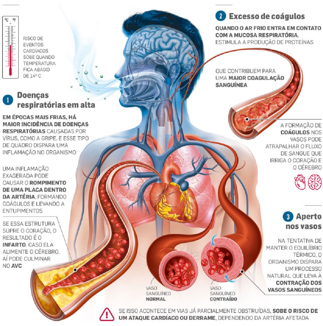 Quais os sintomas do infarto e os fatores de risco para a doença?